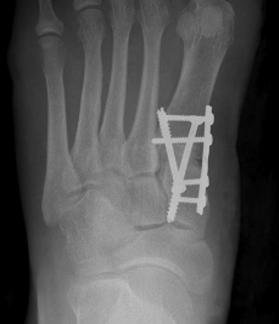 Hallux Valgus Lapidus Procedure